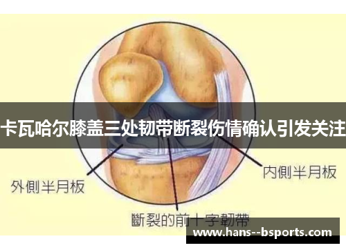 卡瓦哈尔膝盖三处韧带断裂伤情确认引发关注